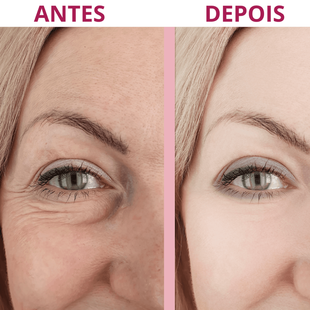 Imagem comparativa antes e depois do uso do sérum Rosa Amazônica, mostrando redução visível de rugas profundas na região dos olhos e melhora na textura da pele.