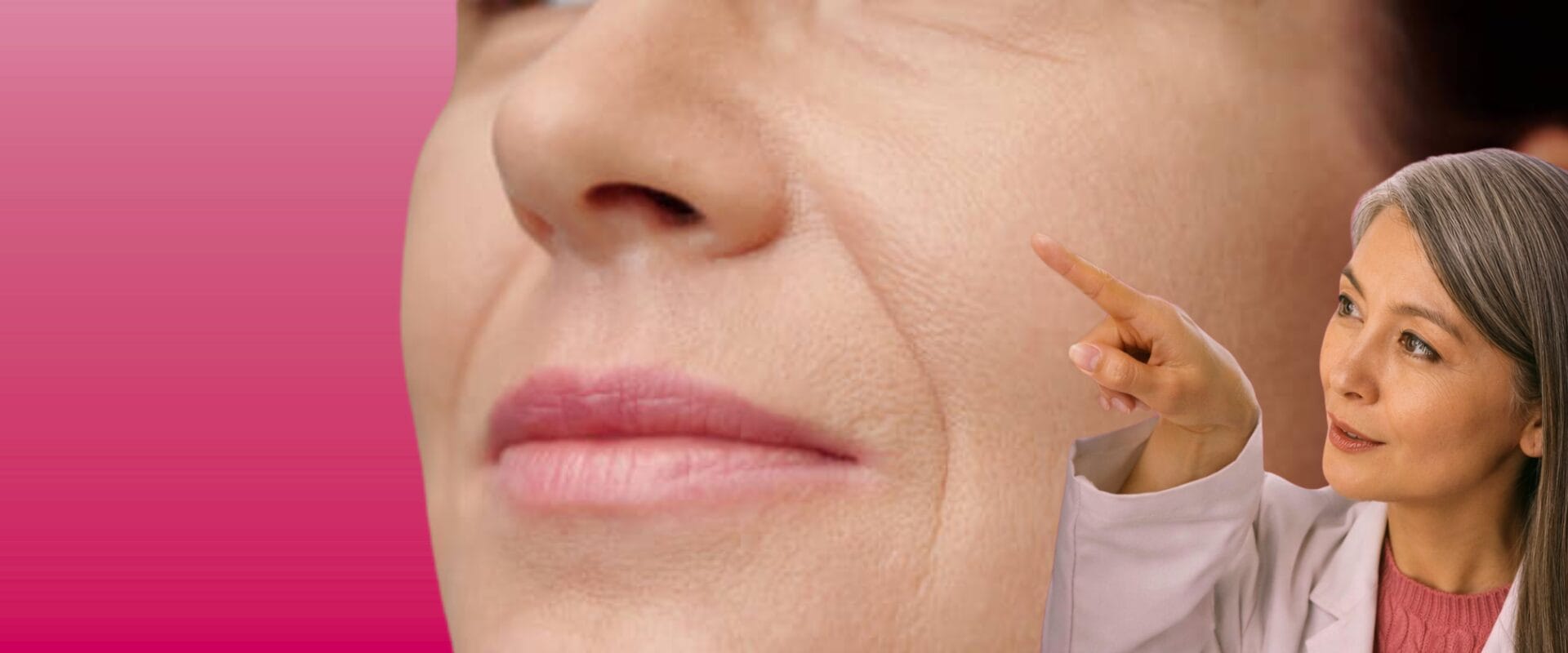 Bigode chinês no rosto feminino mostrando linhas de expressão profundas ao lado do nariz e boca e especialista indicando tratamento anti rugas eficaz