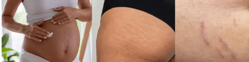 Imagens de barriga grávida hidratada e pele com estrias tratadas com óleo de rosa mosqueta, mostrando resultados visíveis na redução de marcas.