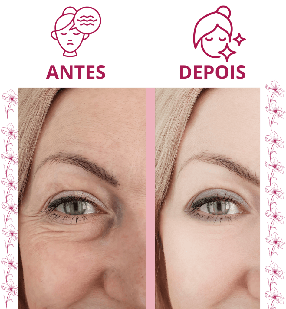 Antes e depois do uso do sérum Rosa Amazônica na área dos olhos, mostrando redução visível de rugas e linhas finas.